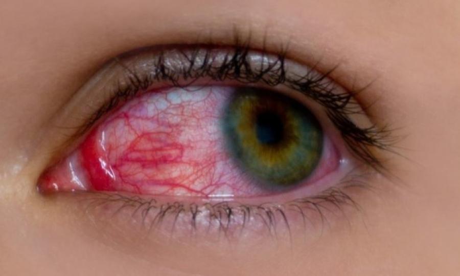 Ραγοειδίτιδα: Αίτια και σημπτώματα της πιο άγνωστης ασθένειας των ματιών
