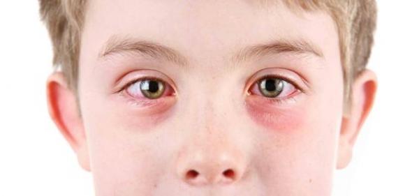 Αλλεργία των ματιών - Οφθαλμική αλλεργία