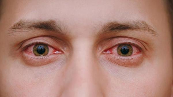 Κοκκίνισμα ματιών: 5 κοινές αιτίες &amp; πώς θα το προλάβετε